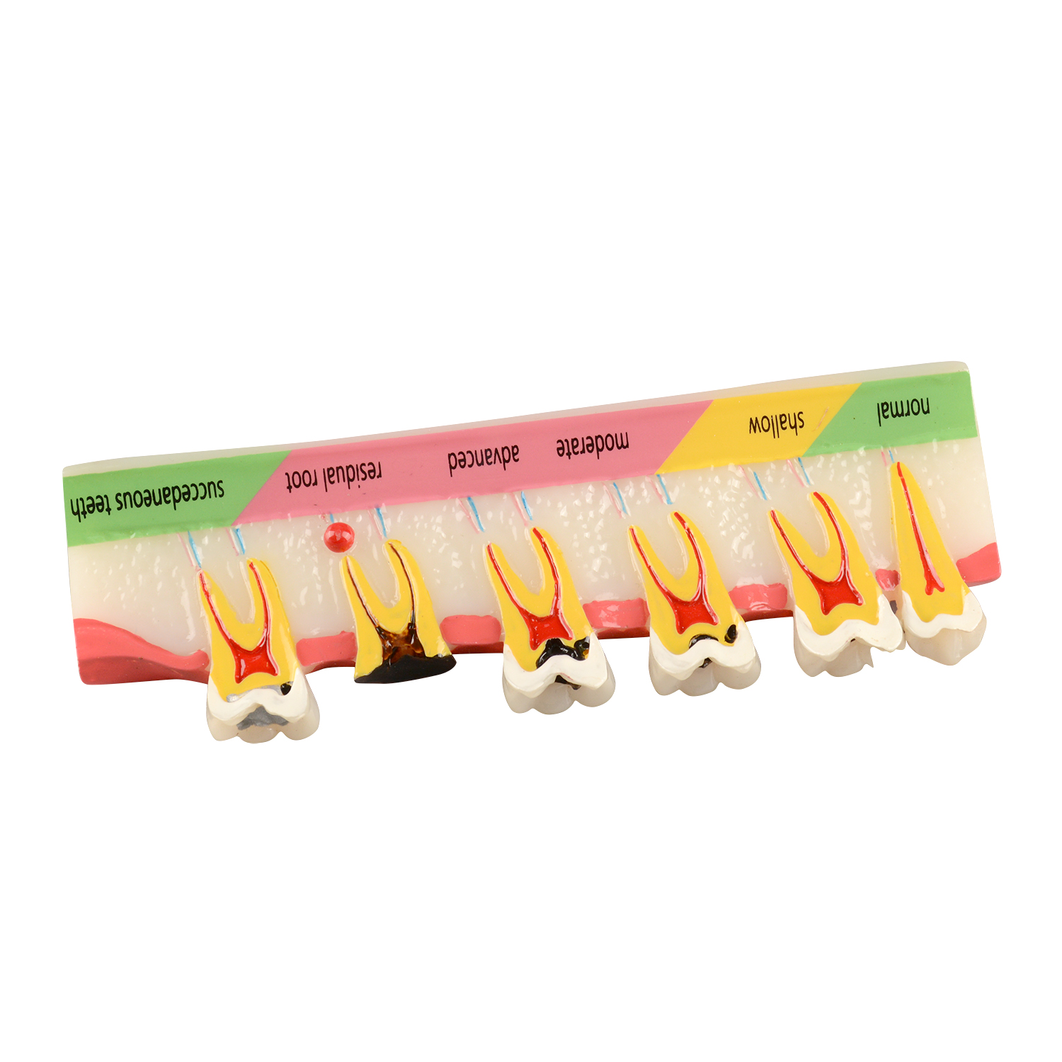 Tooth Decay Development Model, 5 Dental Caries Stages