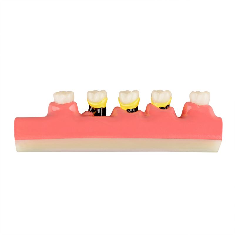 Periodontal Disease Classification Model
