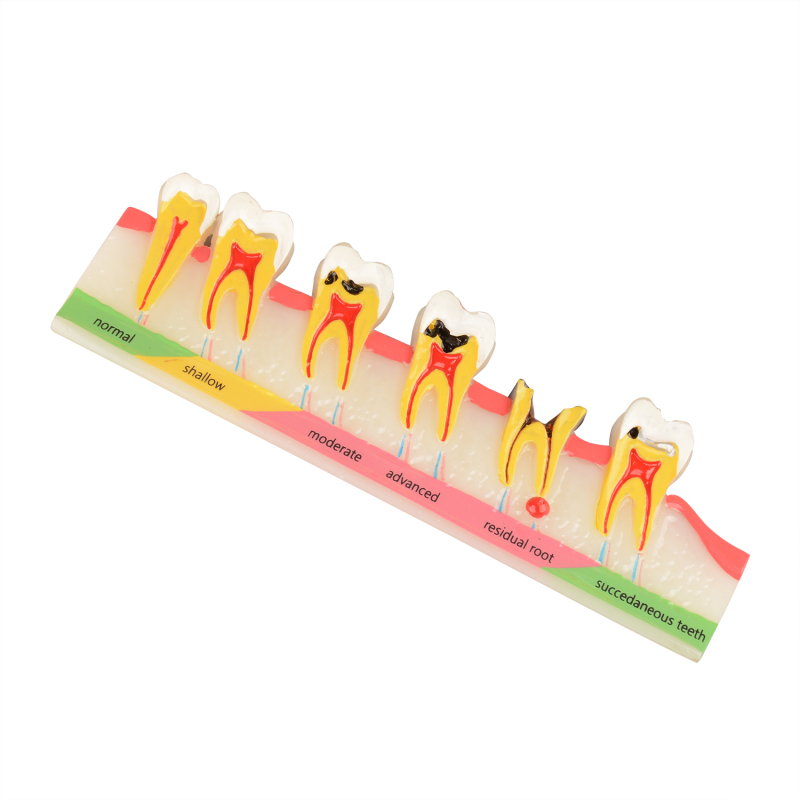 Tooth Decay Development Model, 5 Dental Caries Stages