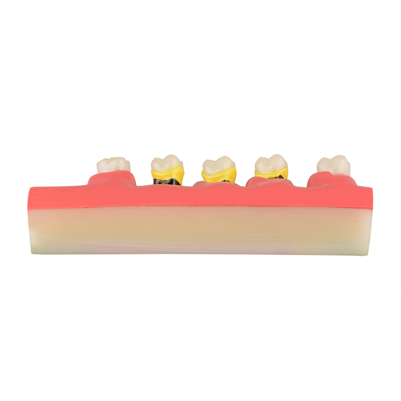 Periodontal Disease Classification Model