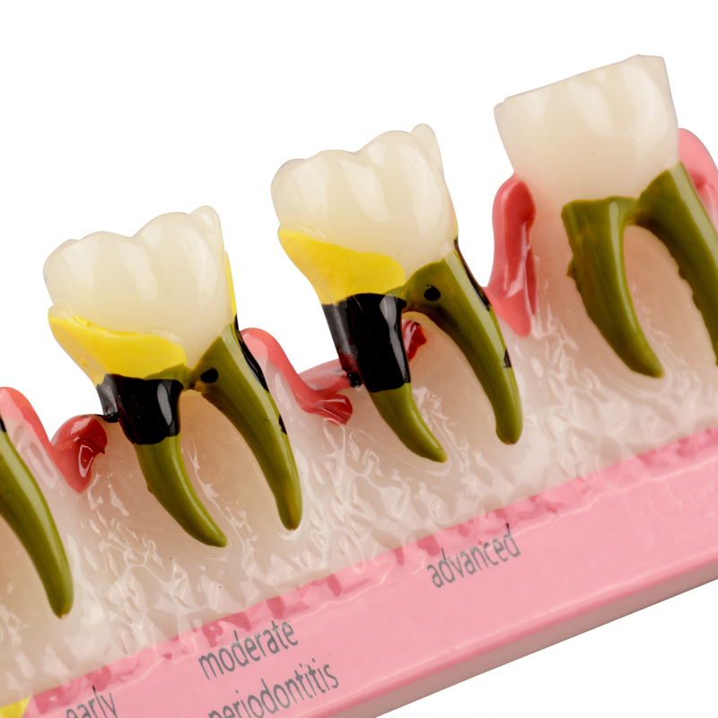 Periodontal Disease Classification Model