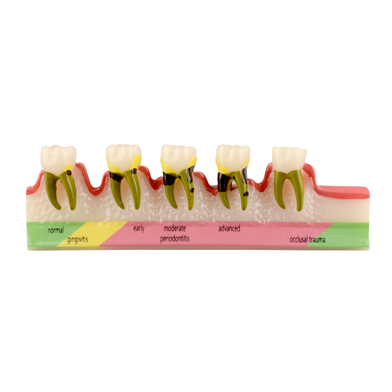 Periodontal Disease Classification Model