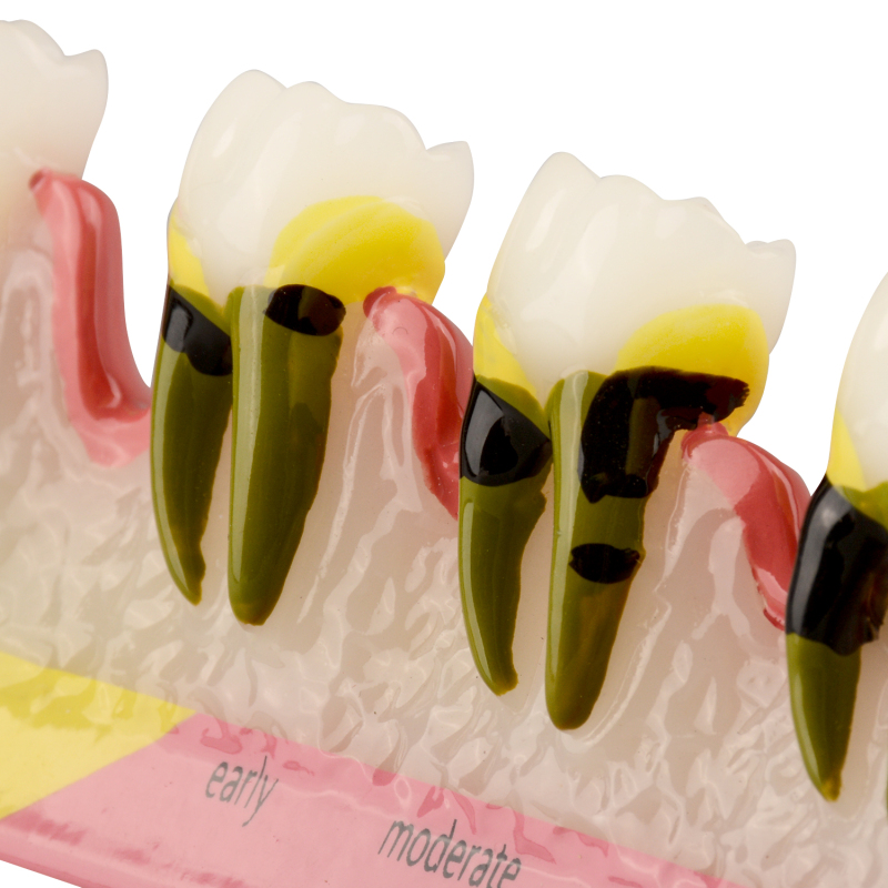 Periodontal Disease Classification Model