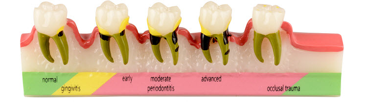 Periodontal disease classification model for patient education or dental teaching