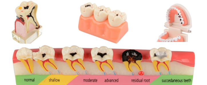 tooth decay teaching model for dental classes & dentisits