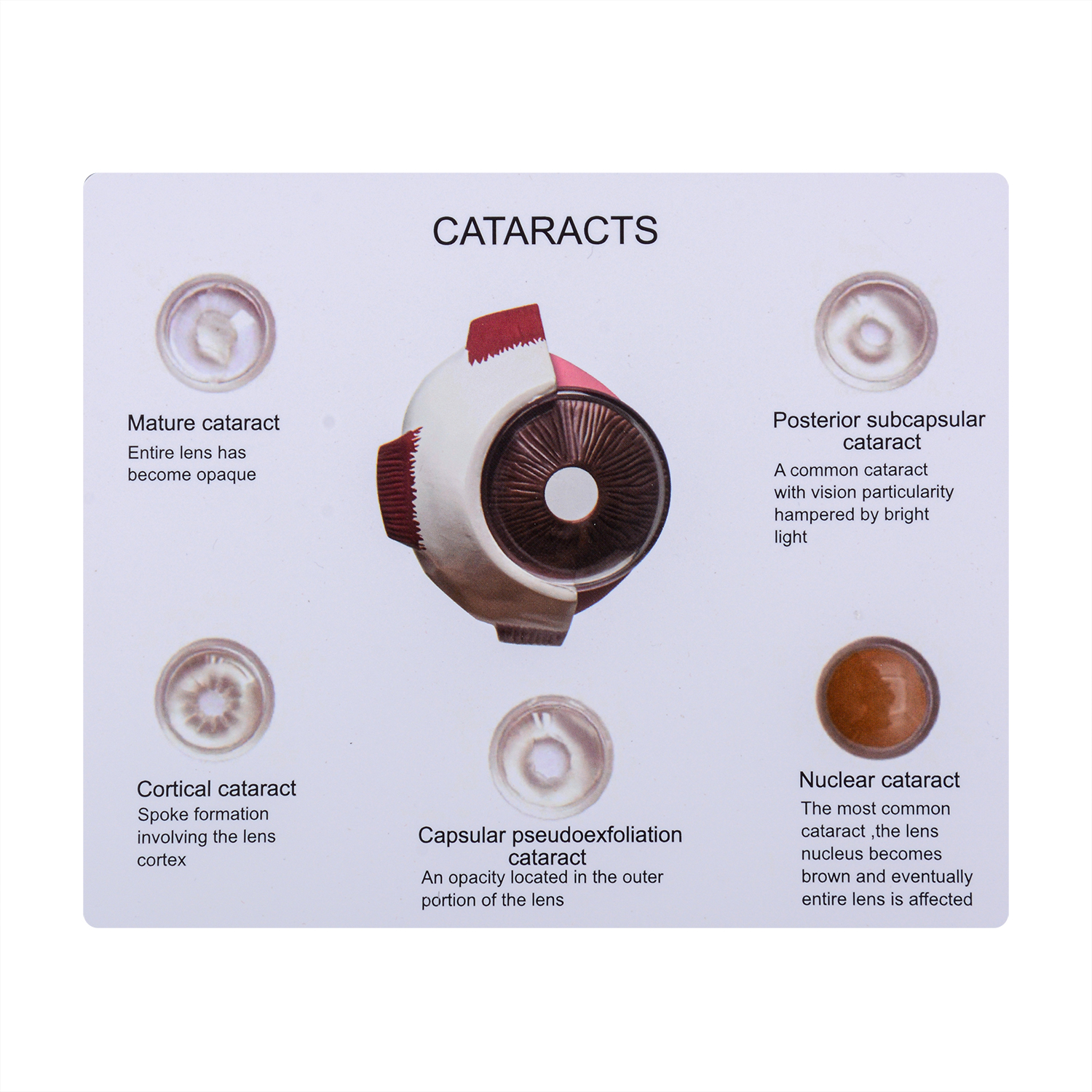 Oversized Human Cataract Eye Anatomy Model for Patient Education