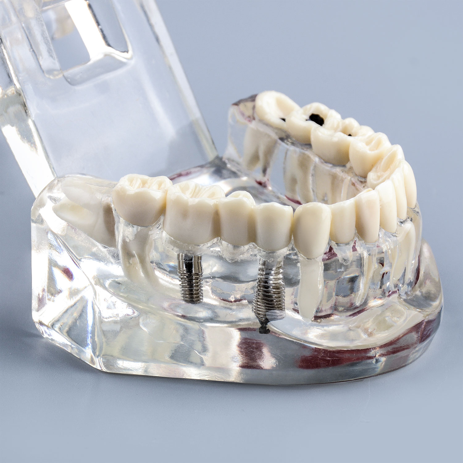 Transparent Teeth Model with Tooth Decay & Pathological Tooth Root