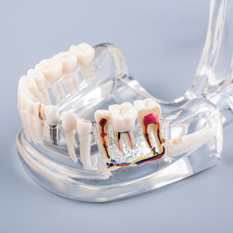 Transparent Disease Teeth Model Missing Gum for Patient & Student Education