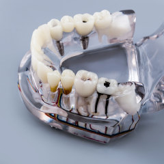 Transparent Pathological Teeth Root Model with Dental Implants