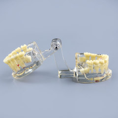 Clear Teaching Disease Teeth Model with Deciduous Teeth