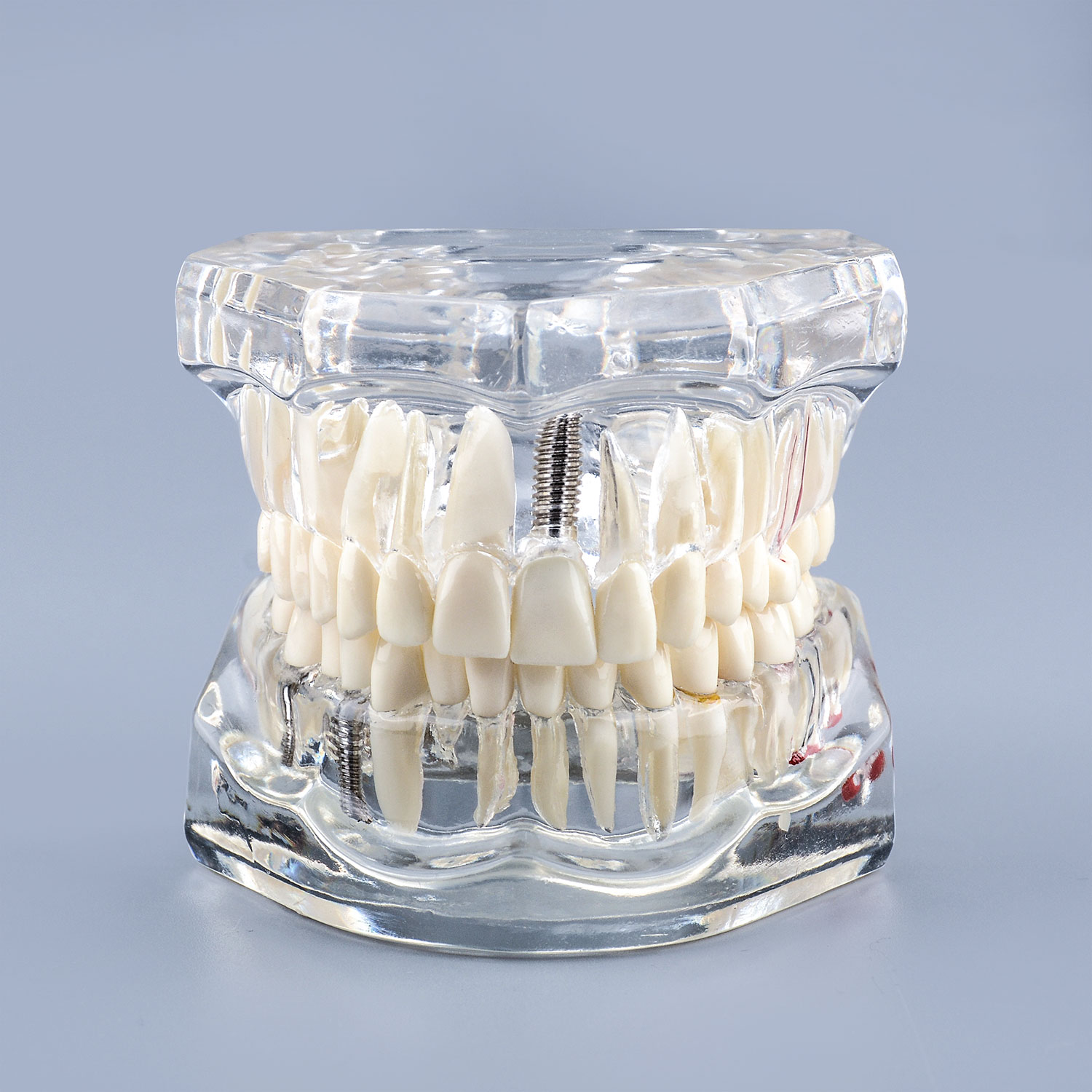 Transparent Teeth Model with Tooth Decay & Pathological Tooth Root