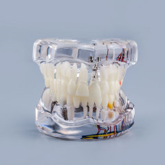 Transparent Pathological Teeth Root Model with Dental Implants