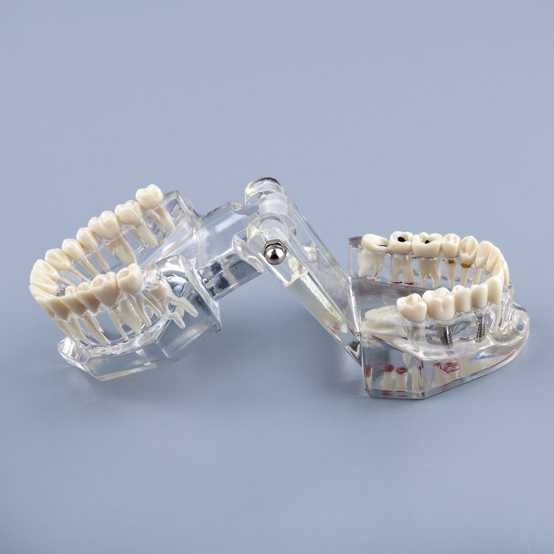 Transparent Teeth Model with Tooth Decay & Pathological Tooth Root