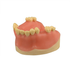 Maxillary Dental Implant Model Missing Partial Teeth 15, 21, 14, 15