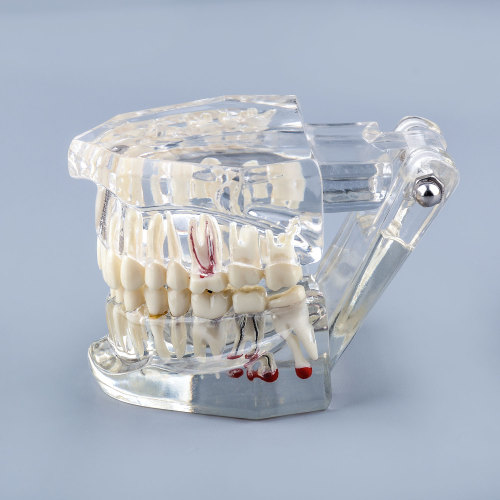 Transparent Teeth Model with Tooth Decay &amp; Pathological Tooth Root