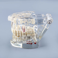 Transparent Teeth Model with Tooth Decay & Pathological Tooth Root