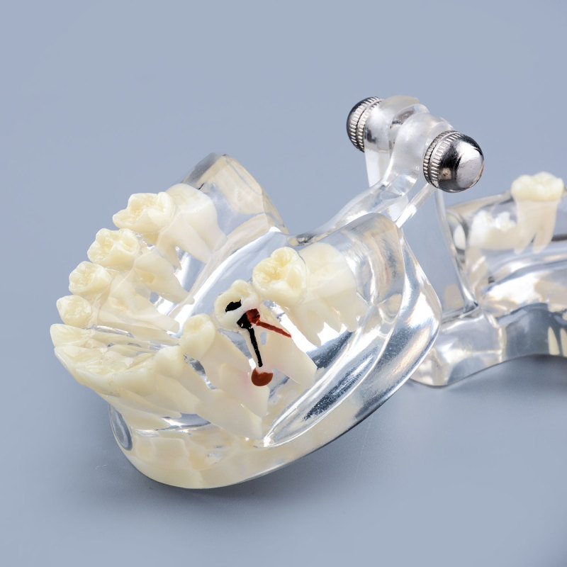 Clear Pathology Teeth Model with Broken Tooth, Root and Gum