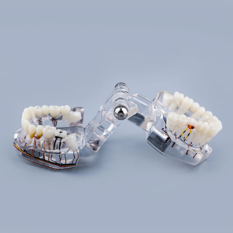 Transparent Pathological Teeth Root Model with Dental Implants