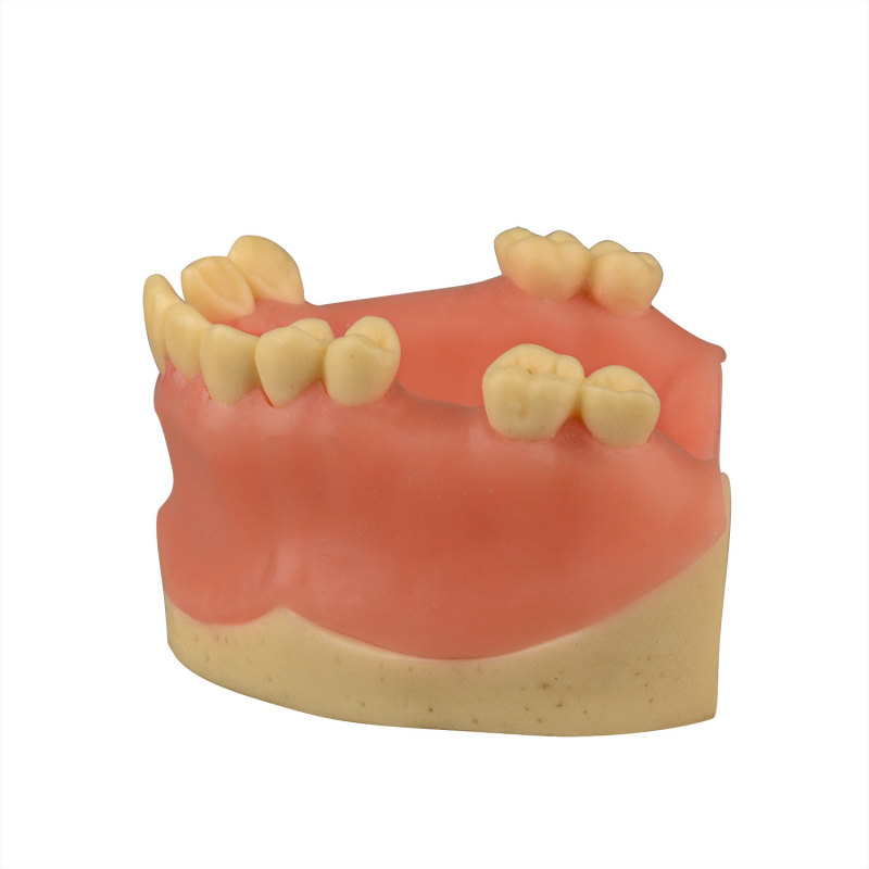 Maxillary Dental Implant Model Missing Partial Teeth 15, 21, 14, 15