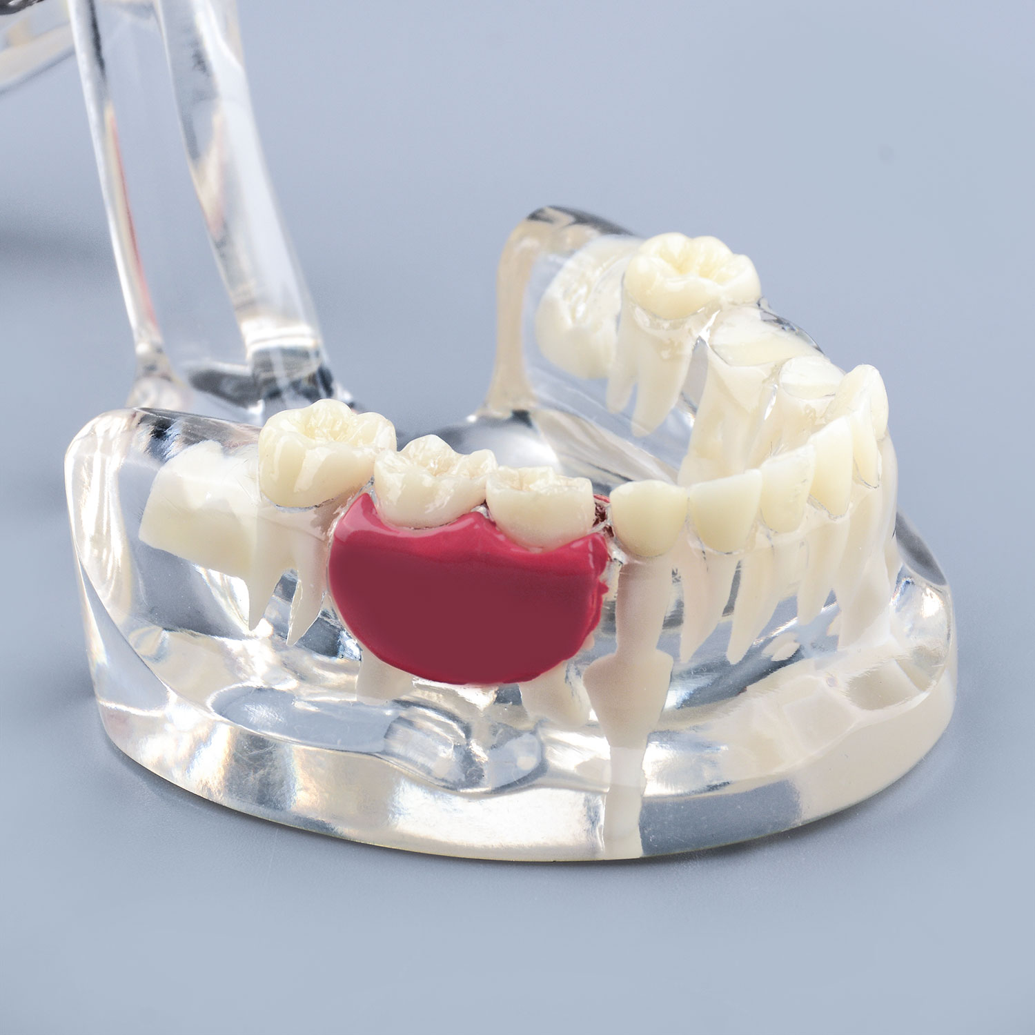 Clear Pathology Teeth Model with Broken Tooth, Root and Gum