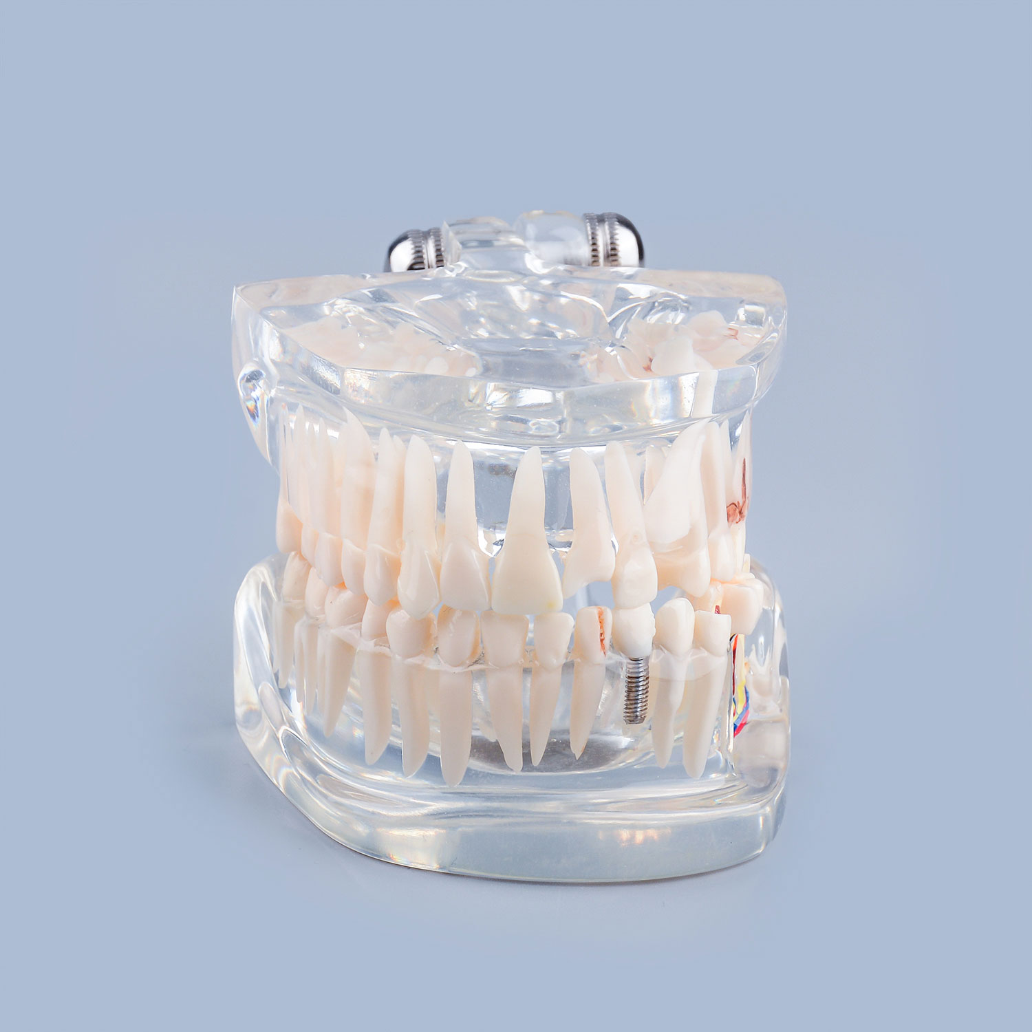Transparent Disease Teeth Model Missing Gum for Patient & Student Education