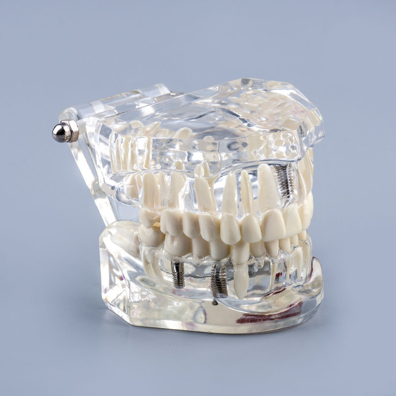 Transparent Teeth Model with Tooth Decay & Pathological Tooth Root