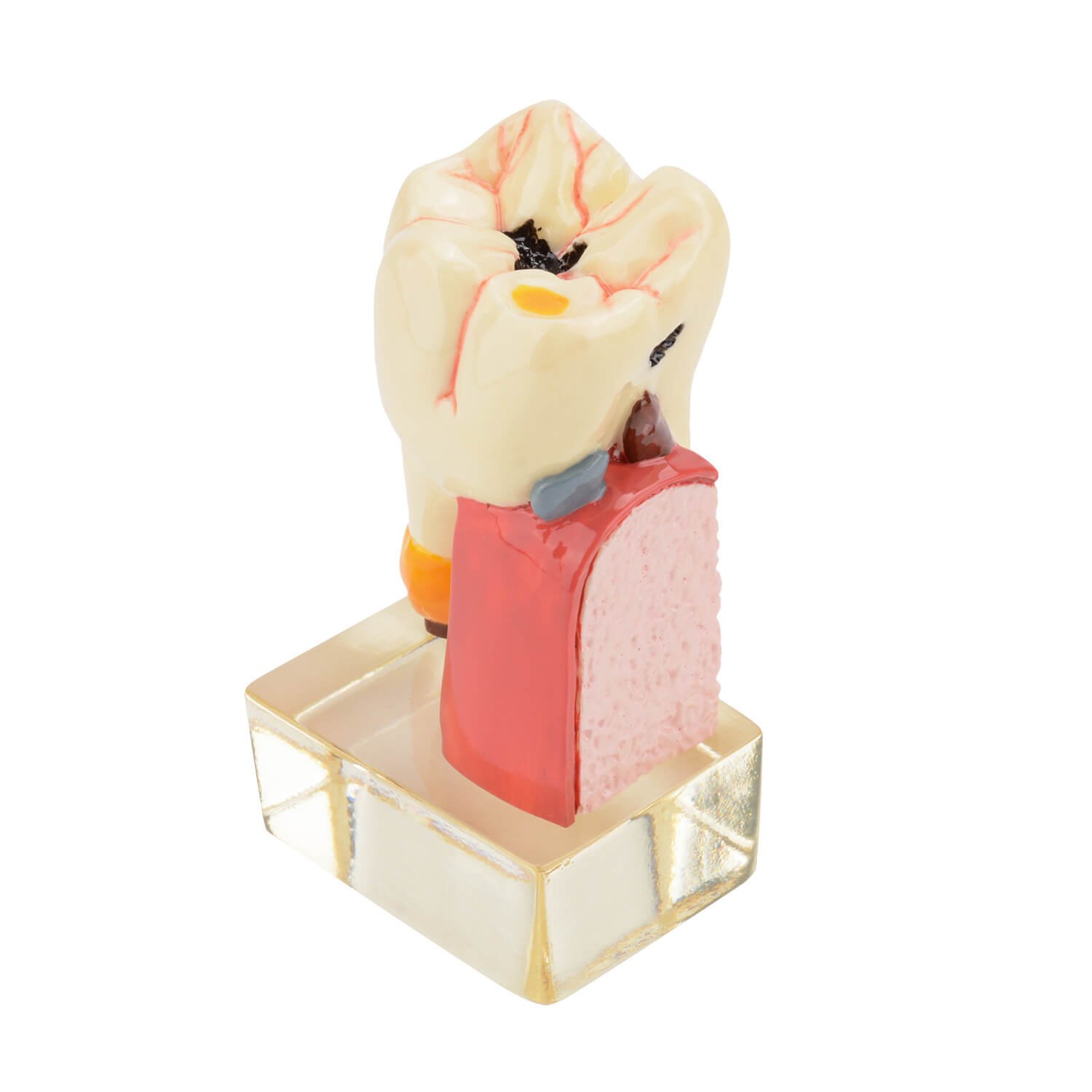 4 Times Tooth Caries Comprehensive Pathological Display Model with Nerve