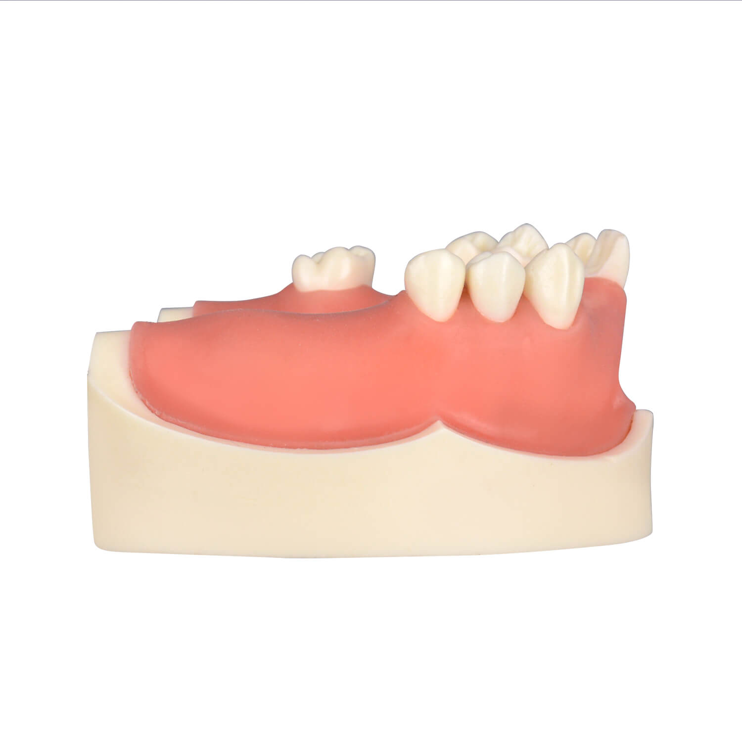 Maxillary Implant Surgery Practice Model, Missing 17, 12, 11, 21, 22, 26, 27 Teeth