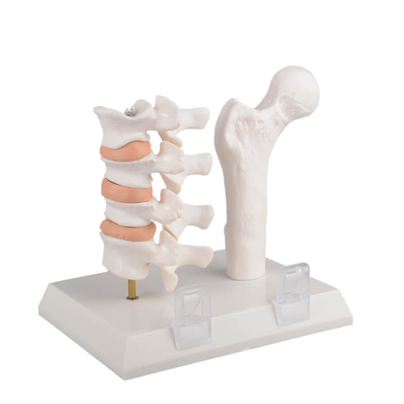 Menopausal Osteoporosis Model (OP Femur & 4 Vertebrae) for Medical Teaching