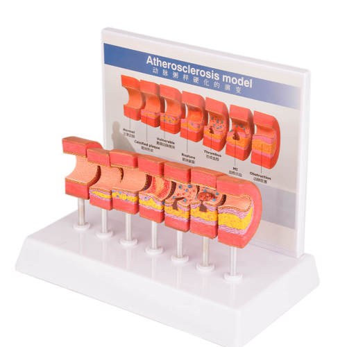 Atherosclerosis Model with 6 Evolutionary Stages