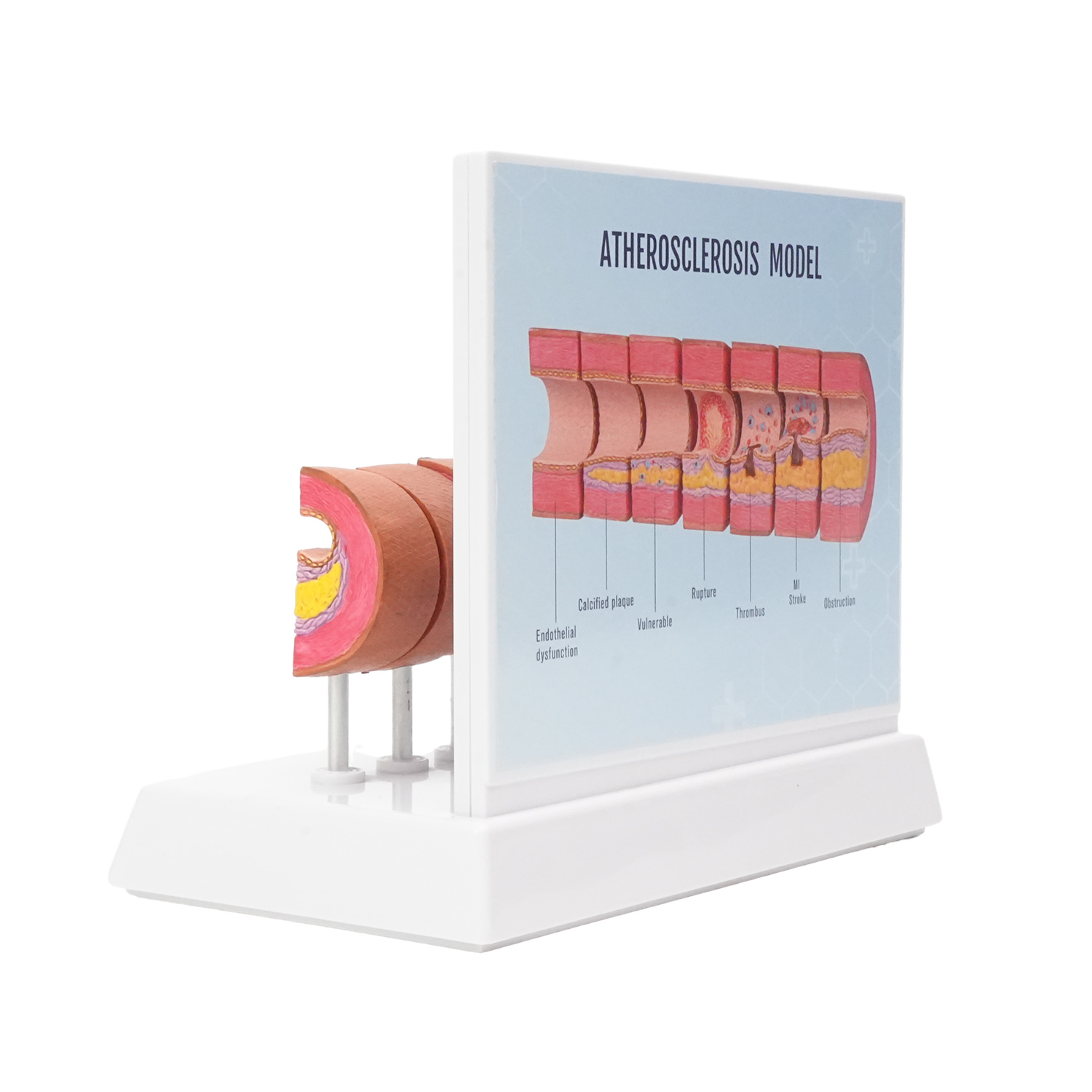 Atherosclerosis Model with 6 Evolutionary Stages