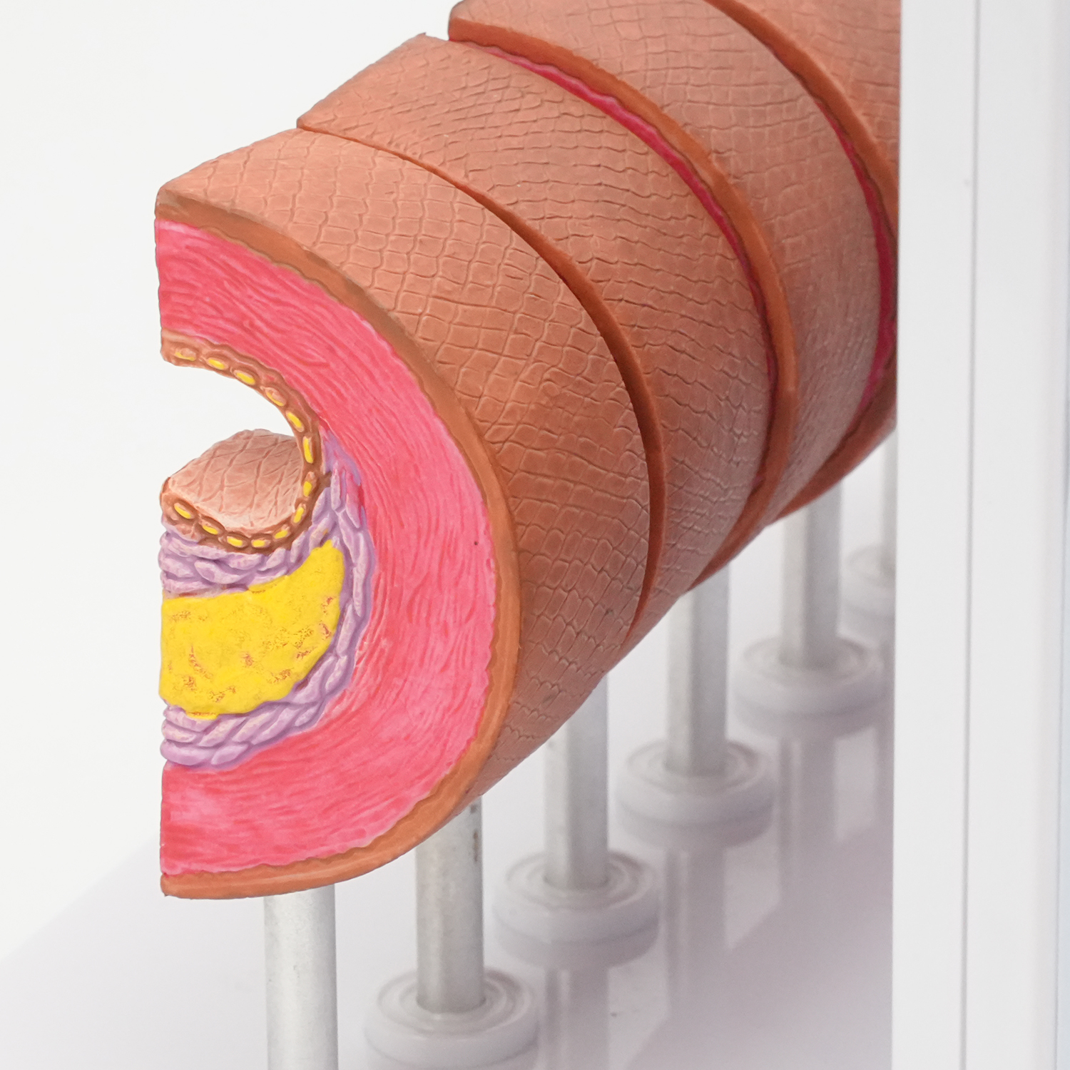 Atherosclerosis Model with 6 Evolutionary Stages