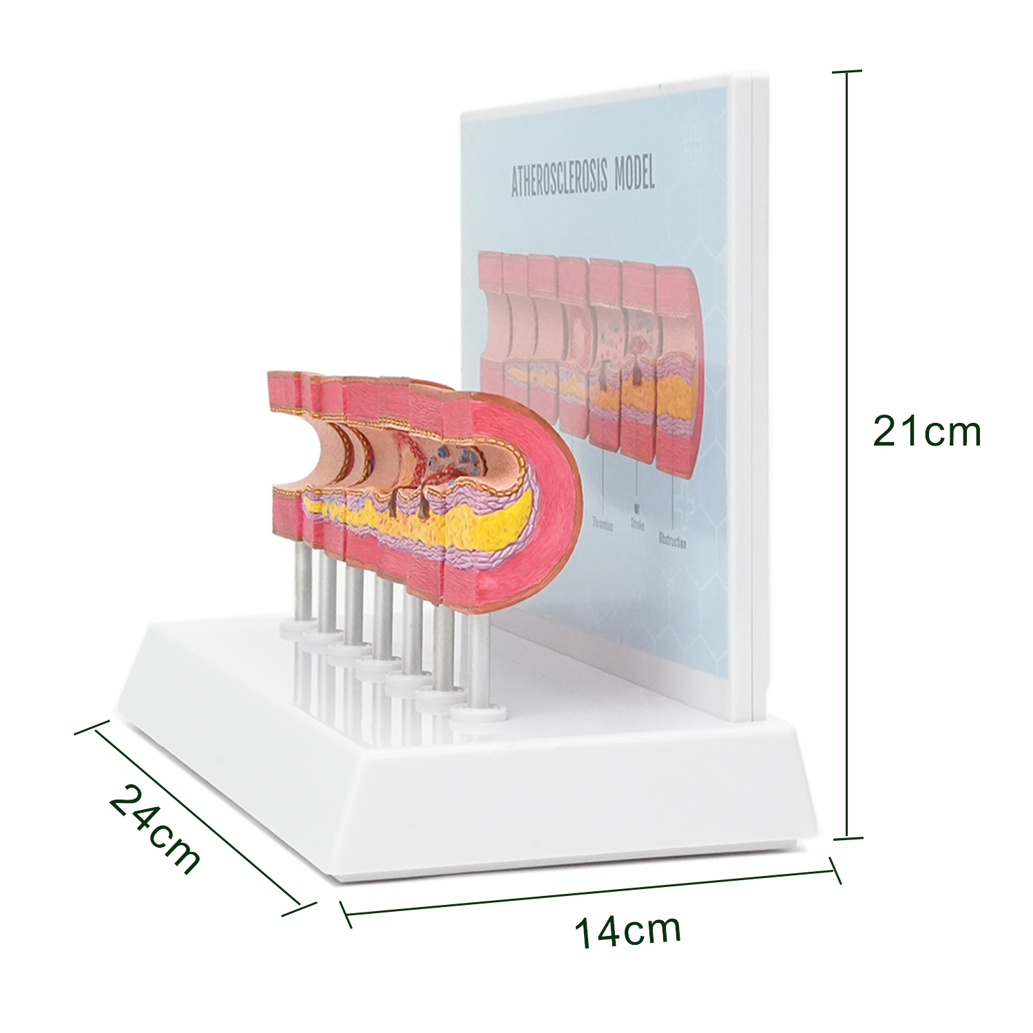 Atherosclerosis Model with 6 Evolutionary Stages