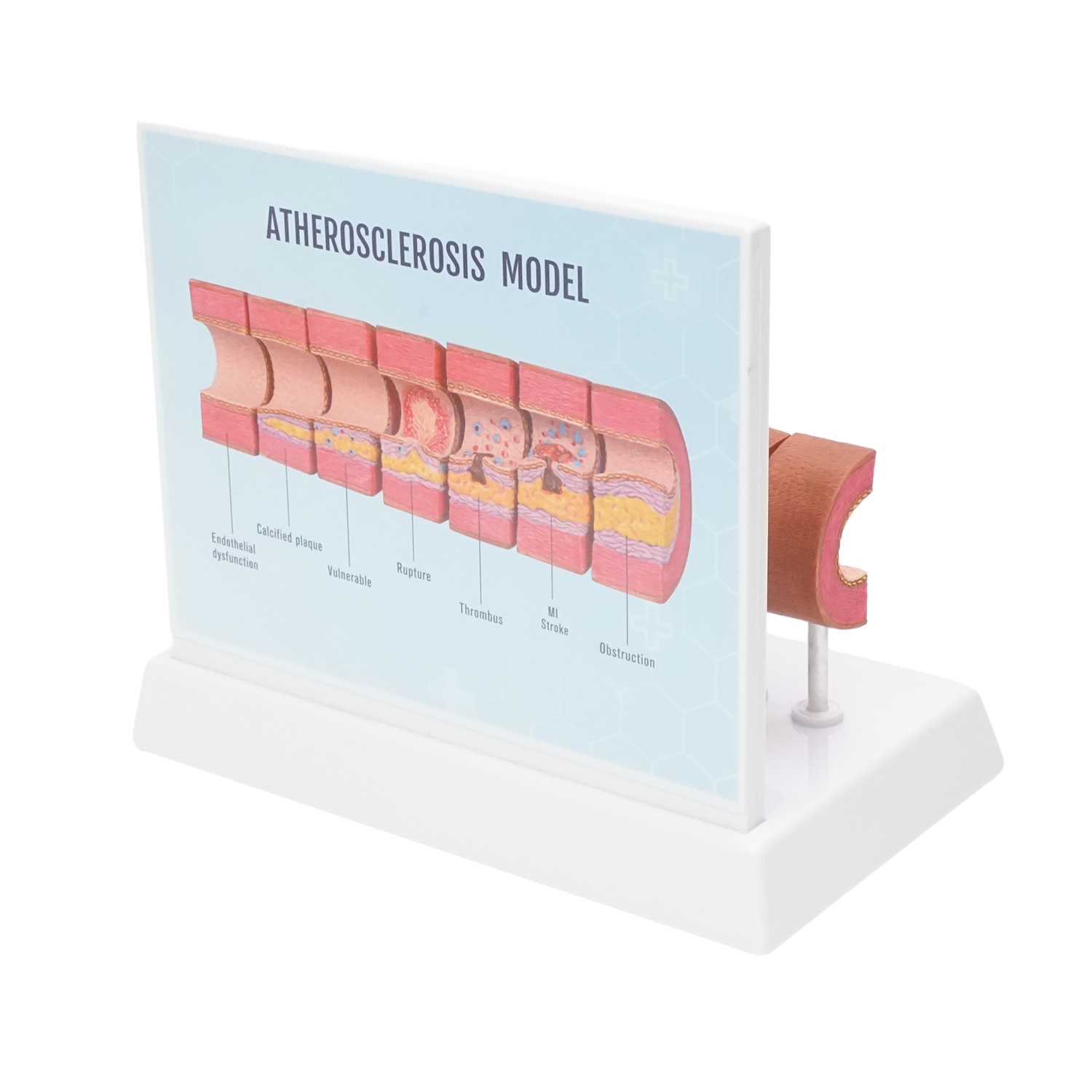 Atherosclerosis Model with 6 Evolutionary Stages