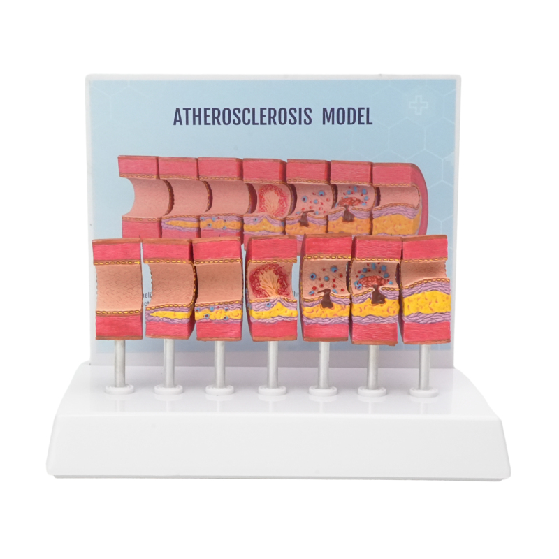 Atherosclerosis Model with 6 Evolutionary Stages