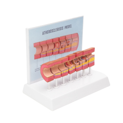 Atherosclerosis Model with 6 Evolutionary Stages