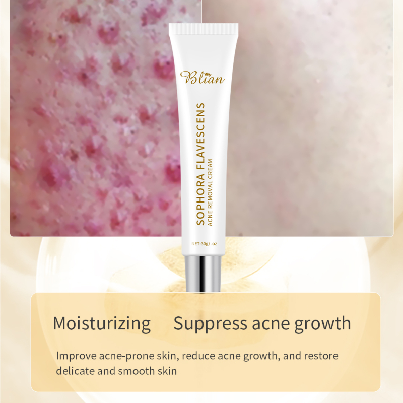 Sophora Flavescens Chinese Herbal Ance Treatment Face Cream