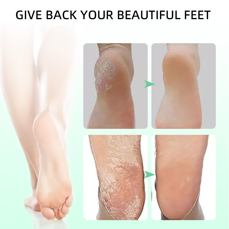 Cracked Foot Skin Repair Cream