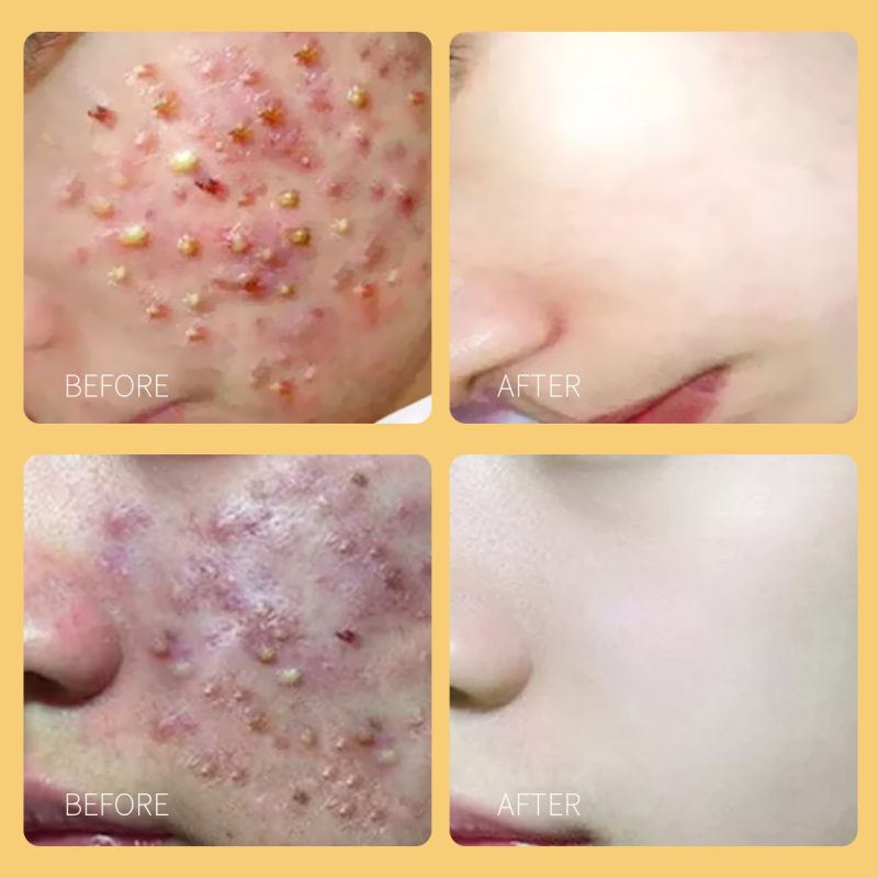 Sophora Flavescens Chinese Herbal Ance Treatment Face Cream