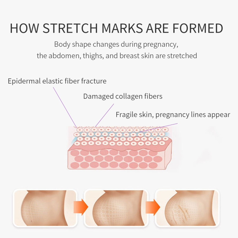 Centella Asiatica Extractsreduce Stretch Marks Moisturisebellycream