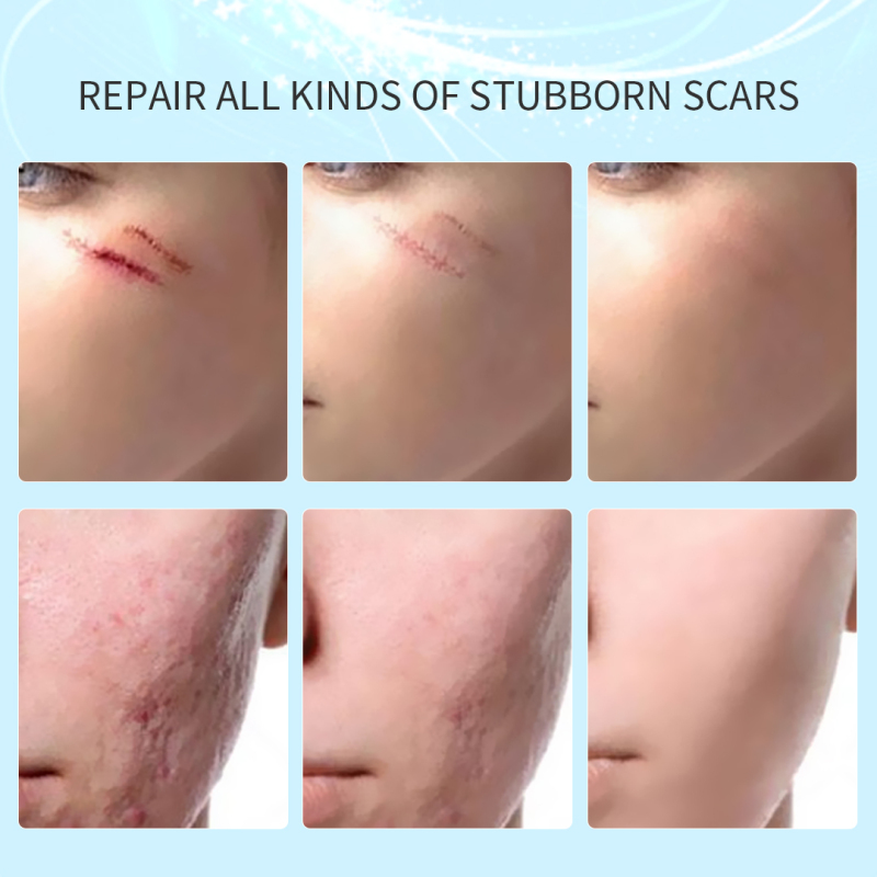 Angelica Sinensis Acne Removing & Scar Fading Body Cream