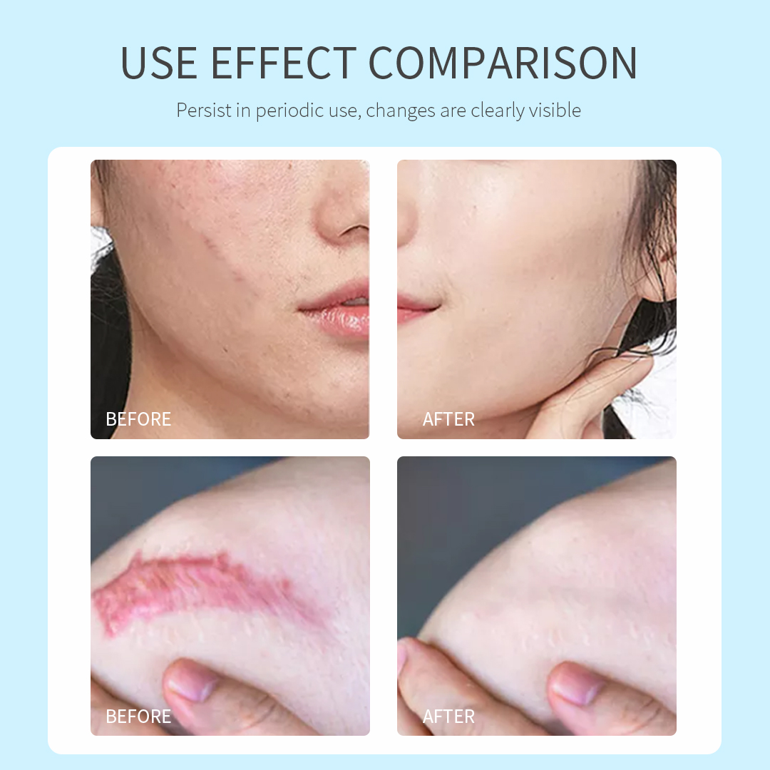 Angelica Sinensis Acne Removing & Scar Fading Body Cream