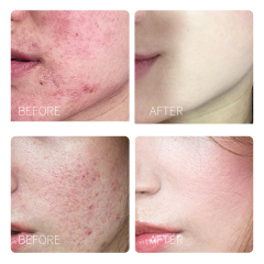 Tea Tree Witch Hazel Remove Acne And Tighten Pores Facial Toner