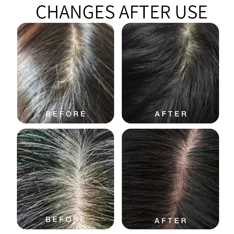 Polygonum multiflorum essence anti hair loss hair care kit