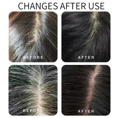 Polygonum multiflorum essence anti hair loss hair care kit
