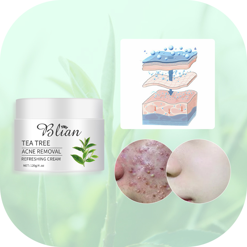Tea Tree Extract Acne Facial Cream