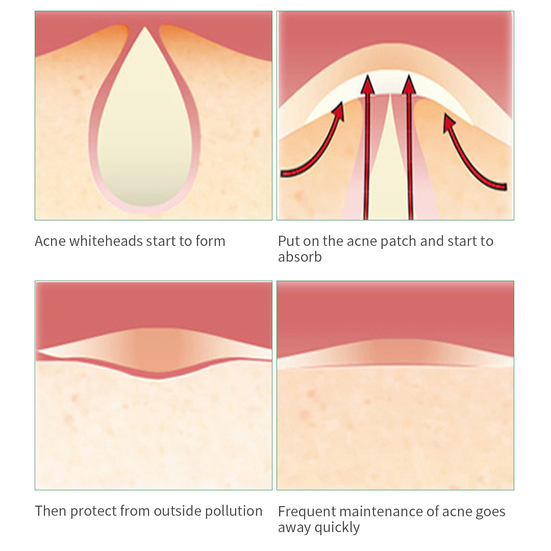 Tea Tree Extract Facial Acne Patch