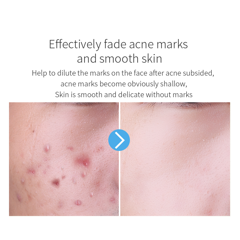 Anti-Blemish Facial Serum