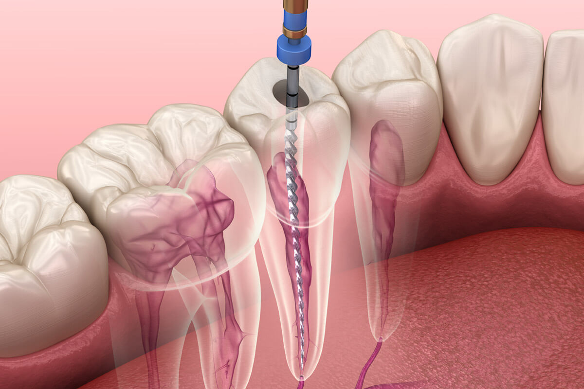 Root Canal Treatment Side Effects and Recovery