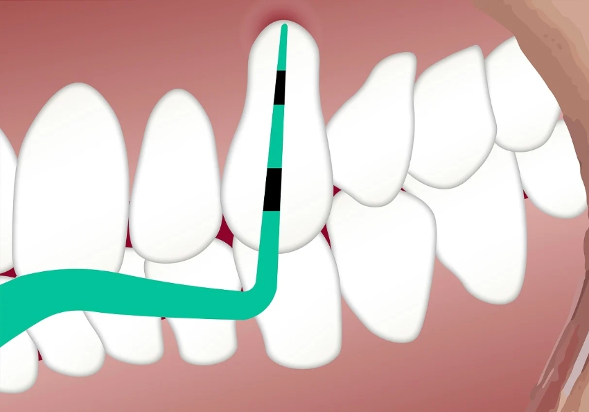 Mastering Dental Mirrors and Probes for Accurate Diagnosis